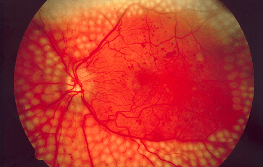 diabetic retinopathy 1