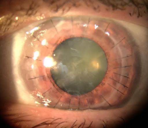 keratoconus 1