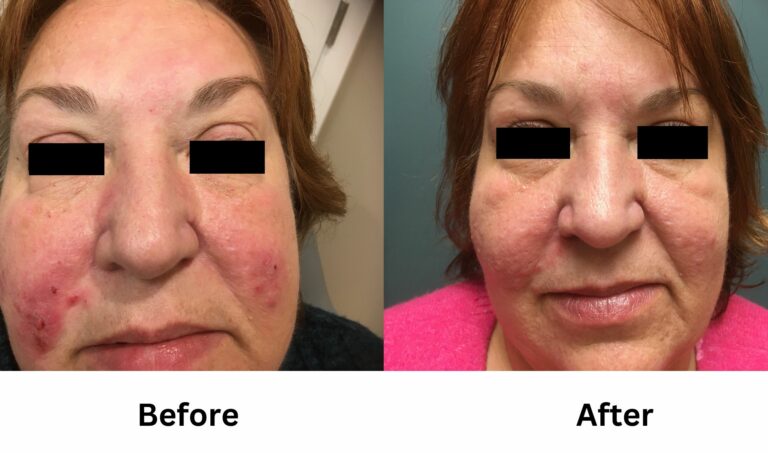 ipl treatment before and after